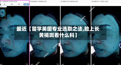 最近【留学英国专业选取之法,脸上长黄褐斑看什么科】-第3张图片